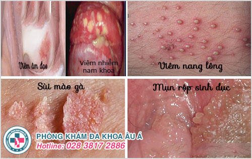 Mọc mụn vùng kín nhưng không đau là bị bệnh gì?