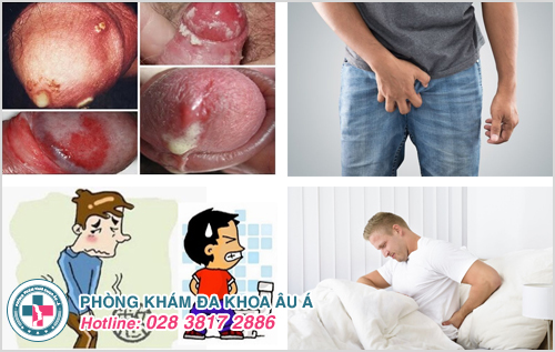 Một số triệu chứng khi bị viêm nhiễm bộ phận sinh dục nam giới