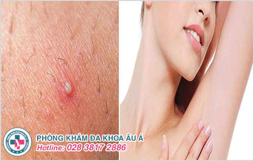 Nếu không được điều trị đúng cách, mụn mủ ở nách có thể gây bội nhiễm, lây lan sang các vùng da xung quanh.