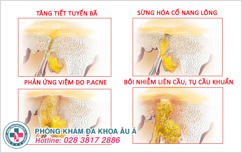 mụn trứng cá nặng