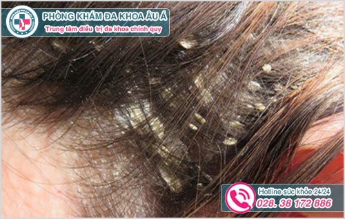 Nấm da đầu: Hình ảnh nguyên nhân biểu hiện và cách chữa