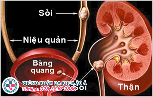 Bệnh sỏi tuyến tiền liệt là gì?