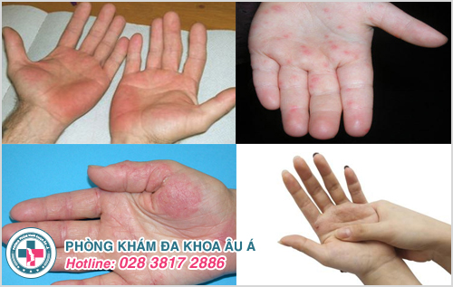 Ngứa lòng bàn tay : Nguyên nhân dấu hiệu cách chữa trị