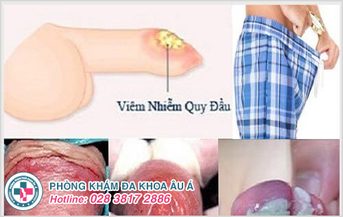 Viêm nhiễm ở bộ phận sinh dục