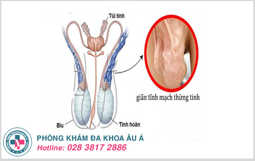 Giãn tĩnh mạch tinh tăng nguy cơ xảy ra hiện tượng tinh hoàn bên to bên nhỏ 