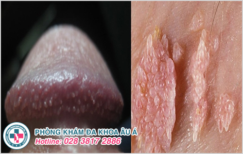 nguyên nhân gây bệnh sùi mào gà ở bộ phận sinh dục nam