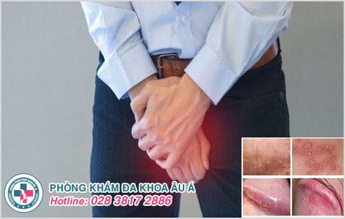 Nguyên nhân nổi mụn dương vật và cách phòng tránh
