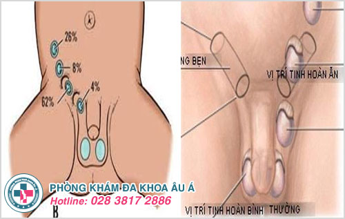 Nguyên nhân và dấu hiệu nhận biết bệnh ung thư tinh hoàn