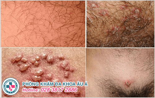 Nhận biết các triệu chứng bệnh herpes sinh dục