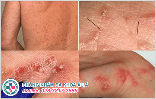 Những bệnh ngoài da có nguy cơ lây nhiễm cần cảnh giác