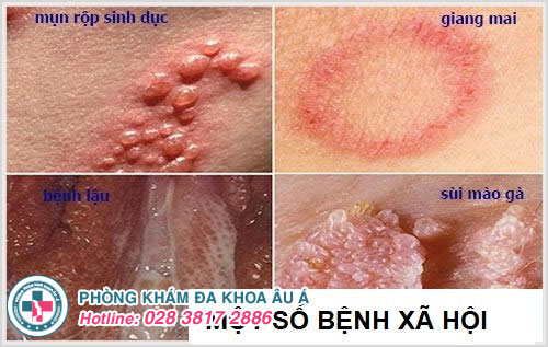 Những bệnh tình dục bạn nên biết