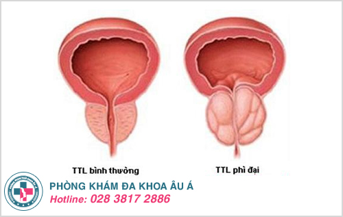 Phì đại tuyến tiền liệt