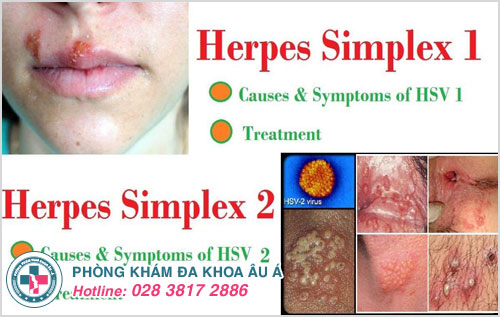 Herpes Simplex 1 và Herpes Simplex 2 gây ra bệnh mụn rộp sinh dục