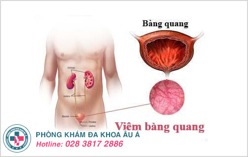 Những dấu hiệu viêm bàng quang thường gặp nhất