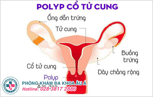 triệu chứng của polyp cổ tử cung