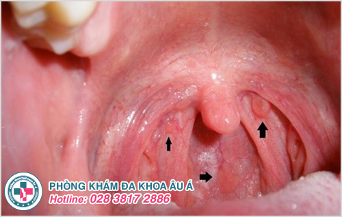 U lồi nhỏ, mềm treo da xuất hiện