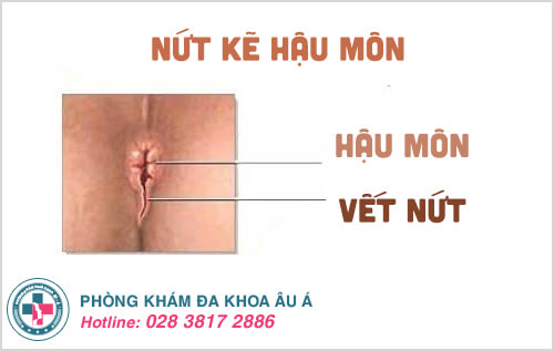 Góc nhìn hậu trường về nứt kẽ hậu môn mãn tính và cấp tính