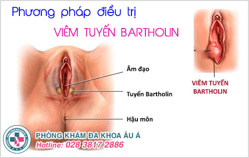 Phương pháp điều trị hiệu quả bệnh viêm tuyến Bartholin