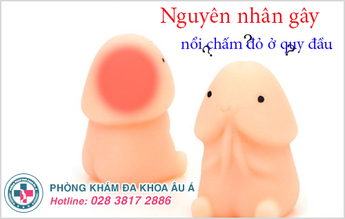 Nguyên nhân gây nổi chấm đỏ ở quy đầu