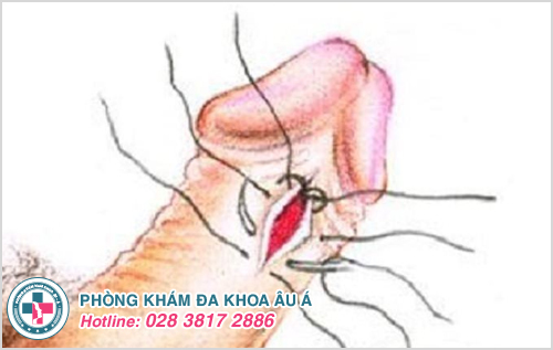 Rách bao quy đầu: Hình ảnh nguyên nhân dấu hiệu cách trị