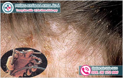 Rận mu ở tóc: Hình ảnh nguyên nhân dấu hiệu và cách trị