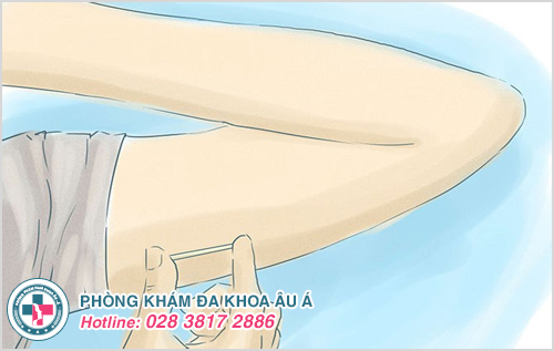 Sử dụng một hoặc nhiều que tránh thai có kích thước nhỏ cấy vào lớp da dưới cánh tay