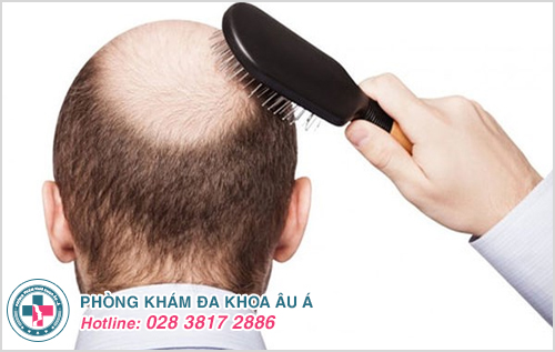 Rụng tóc do di truyền xảy ra phần lớn ở nam giới gây hói đầu