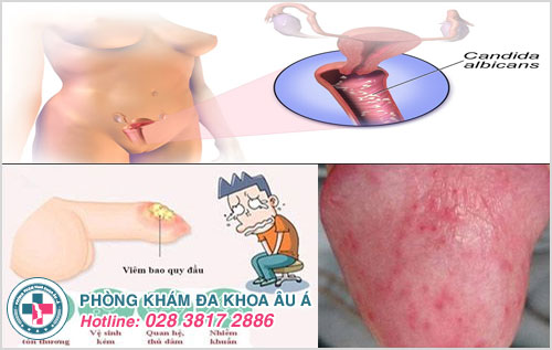 Nấm Candida ở nữ và viêm bao quy đầu ở nam giới là hai bệnh lý gây sau quan hệ vùng kín có mùi hôi