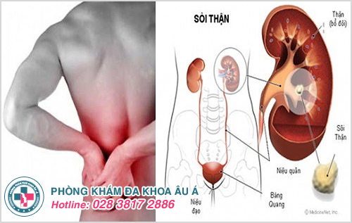 Đi tiểu buốt và đau lưng là dấu hiệu bệnh bệnh sỏi thận