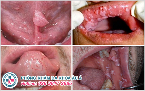 Xét nghiệm HPV ở vòm họng và miệng