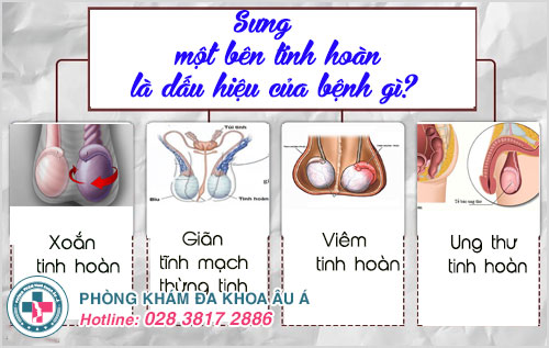 Sưng một bên tinh hoàn, không nên chủ quan