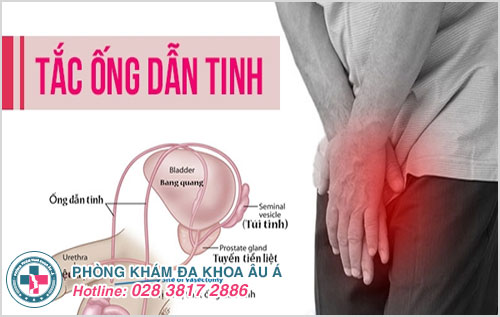 Tắc ống dẫn tinh và cách khắc phục an toàn