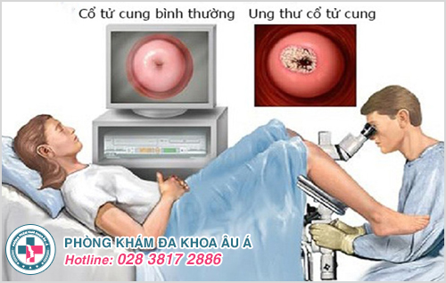 Polyp sẽ có nguy cơ bị rong huyết không do kỳ kinh, chảy máu thường xuyên sau khi quan hệ