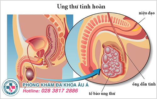 Ung thư tinh hoàn có xu hướng xảy ra ở hầu hết nam giới trẻ tuổi