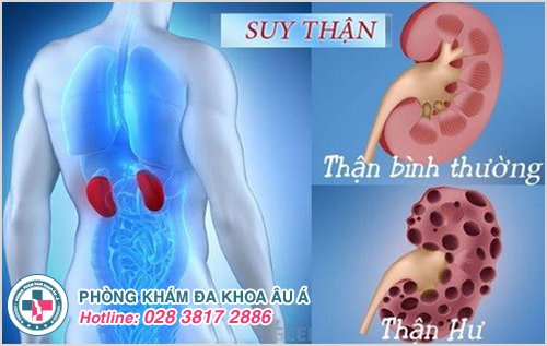 Đi tiểu buốt và đau lưng là dấu hiệu bệnh bệnh thận hư