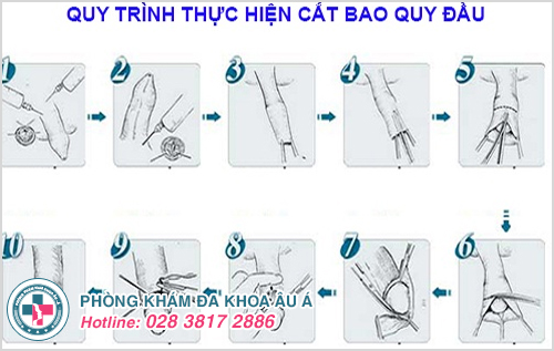 thời điểm nào cắt bao quy đầu tốt nhất