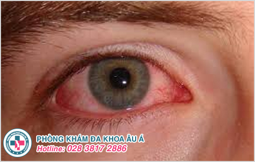 Thủy đậu mọc trong mắt: Nguyên nhân, dấu hiệu và cách điều trị