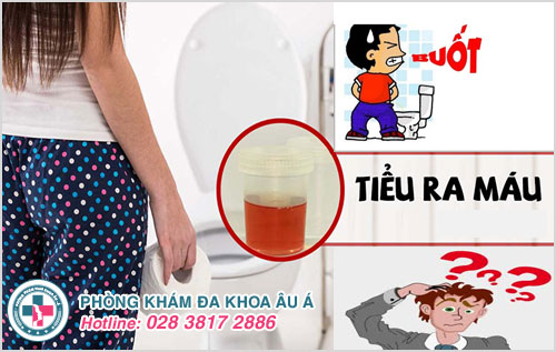 Tiểu buốt ra máu và đau bụng dưới là dấu hiệu bệnh gì?