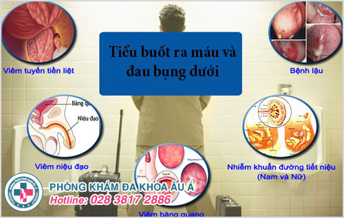 Tiểu buốt ra máu và đau bụng dưới là dấu hiệu bệnh gì