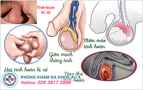 Tinh hoàn bị xệ ở nam giới là dấu hiệu ban đầu của các nhiều bệnh lý khác nhau nguy hiểm