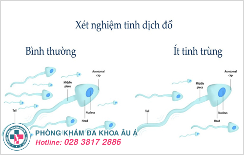 Tinh trùng ít có thụ thai và có con được không