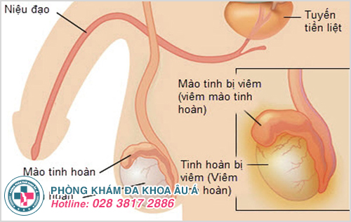Mào tinh hoàn bị vi khuẩn tấn công dẫn đến viêm nhiễm Tinh trùng màu nâu