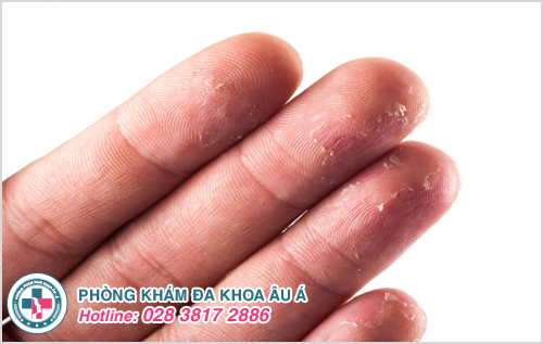 Tróc da đầu ngón tay là bệnh gì? Nguyên nhân và Cách chữa