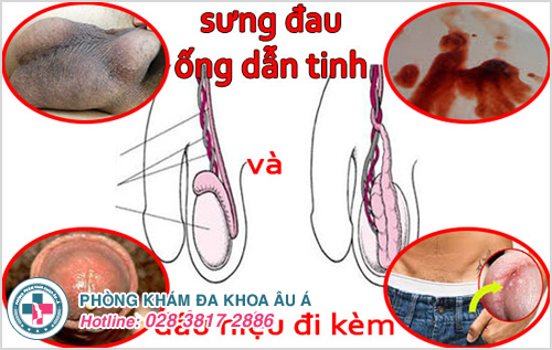 Những dấu hiệu nhận biết bị viêm ống dẫn tinh ở các quý ông