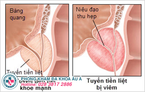 Đi tiểu buốt và đau lưng là dấu hiệu bệnh viêm tuyến tiền liệt ở nam giới