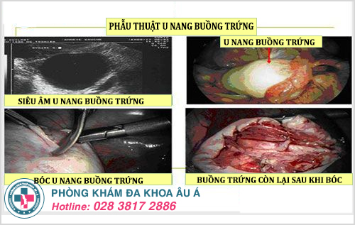 U nang buồng trứng 