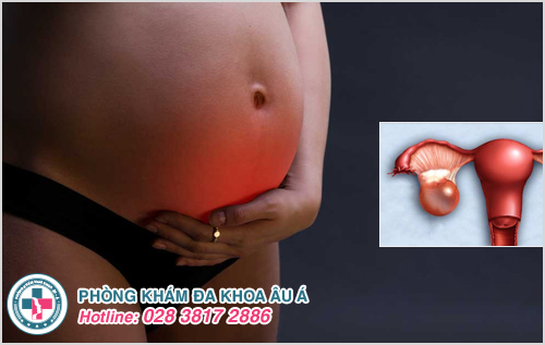 Hình ảnh u nang buồng trứng phải khi mang thai