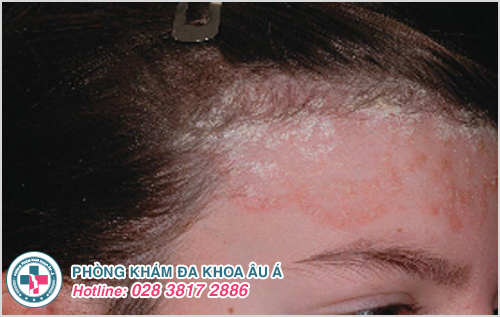 Vảy nến da đầu : Nguyên nhân dấu hiệu và cách điều trị
