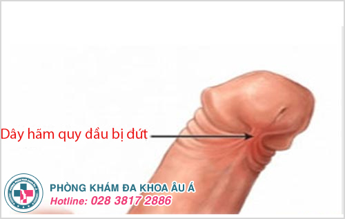 bao quy đầu chảy máu