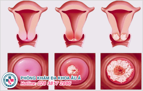 Hình ảnh viêm cổ tử cung